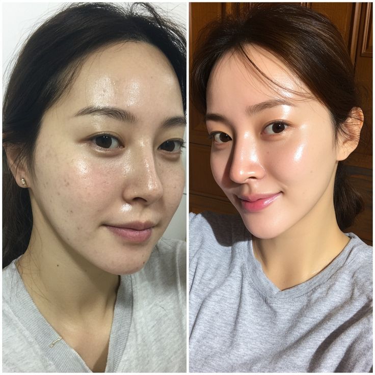 Nên tiêm mesotherapy bằng máy hay bằng tay sẽ hiệu quả hơn?